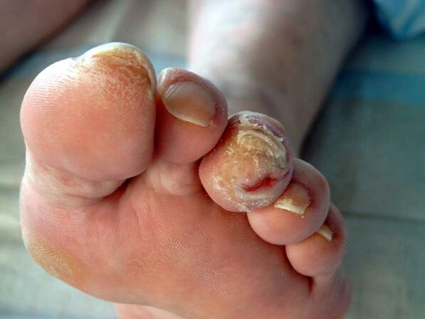 Picior diabetic și onhomomicoză